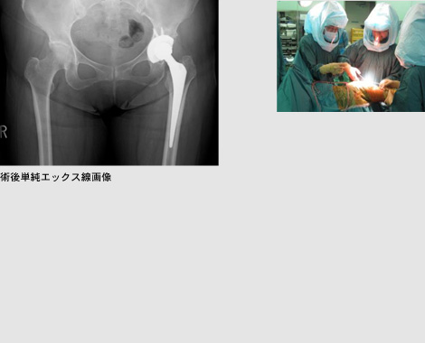 当院で開発した人工関節
A-I Hip system 術後単純エックス線画像